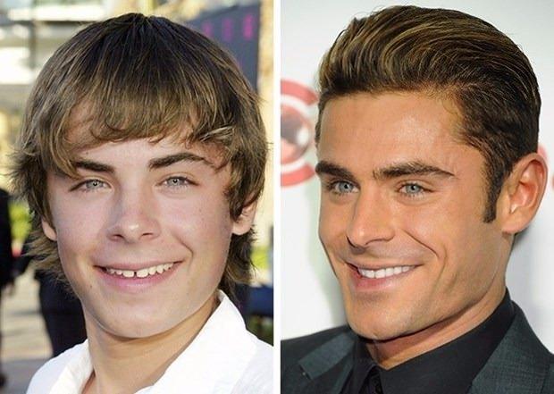 <p>Zac Efron</p>
<p>Zac Efron, ergenlik döneminde ayrık dişleriyle dikkat çekerken daha sonra dişlerine yaptırdığı estetik müdahale ile imajını değiştirdi. Saç stilindeki değişim de 29 yaşındaki oyuncuyu bambaşka biri haline getirdi. </p>