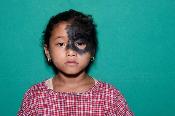 <p><strong>"Hairy Nevus"</strong> olarak bilinen nadir hastalıklardan biri de Urmila Khangaha isimli Nepalli küçük kızın başına geldi. Bu hastalıktan dolayı <strong>küçük kızın yüzünde saç uzuyor. </strong></p>
