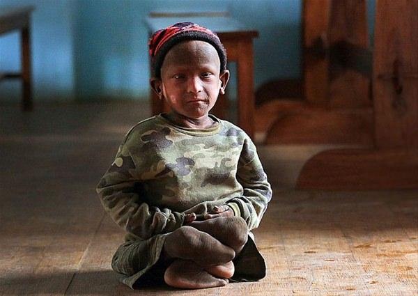 <p>K&uuml;&ccedil;&uuml;k Ramesh o g&uuml;nden beri yavaş&ccedil;a ve &ccedil;ok sancılı bir şekilde kendi derisinin i&ccedil;inde dayanılması g&uuml;&ccedil; acılar &ccedil;ekiyor.<br />
&nbsp;</p>
