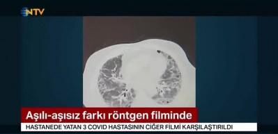 Aşılı ve aşısız hastaların farkı r&ouml;ntgen filminde! İşte &uuml;&ccedil; Kovid hastasının akciğerleri