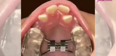 Ortodontik tedavisinin muazzam etkisini bir de b&ouml;yle g&ouml;r&uuml;n