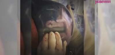 İşte ger&ccedil;ek mucize! Sezaryen doğumda nadir ger&ccedil;ekleşen olay...