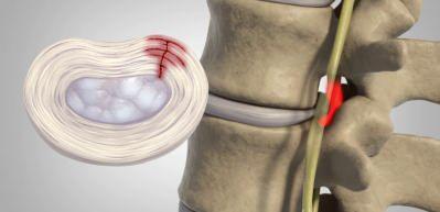 Bel fıtığı neden olur? Bel fıtığı tedavisi var mıdır? Ameliyatsız bel fıtığı ge&ccedil;er mi?