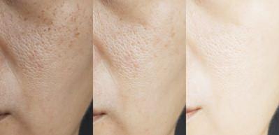 Y&uuml;zde oluşan delikleri giderme y&ouml;ntemleri