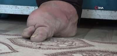 Bacakları her yıl 7 santimetre genişliyor! Tek isteği tekerlekli sandalye...