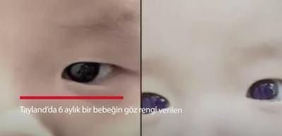 Tayland&rsquo;da 6 aylık bir bebeğin g&ouml;z rengi verilen ila&ccedil;la değişti