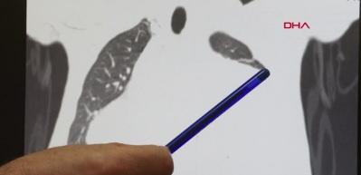 Kalbi 12 cm kayınca hemen ameliyata alındı! işte şaşkınlığa neden olan operasyonun sonrası...