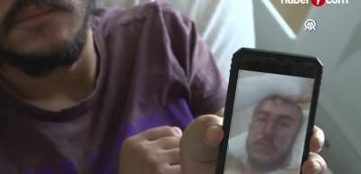 Yıldırım isabet eden &ccedil;obanın bacakları cilt nakli ve cerrahi m&uuml;dahaleyle kurtarıldı