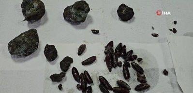 92 yaşındaki kadının karnından 35 zeytin, 28 hurma &ccedil;ekirdeği ile 5 taş &ccedil;ıktı!