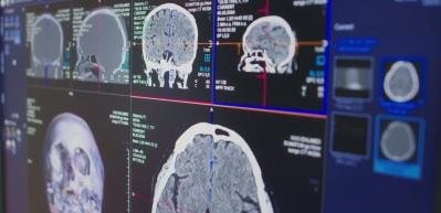 Alzheimer'de bu belirtiye dikkat: Unutkanlığı hafife almayın
