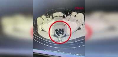 Midesinden yarım kilo metamfetamin çıktı