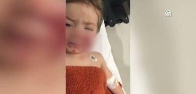 Başkentte pitbull cinsi köpeğin saldırısına uğrayan 2 çocuk yaralandı