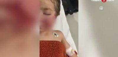 Ankara’da pitbull saldırısı: İki kardeş yaralandı