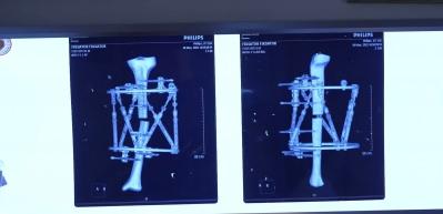 Boy kısalığı artık tarih oluyor! Kemik uzatma ameliyatları artık doğal iyileşme vadediyor