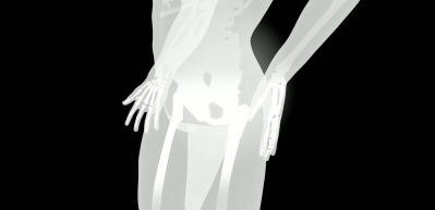 Bebeklerde doğuştan kal&ccedil;a &ccedil;ıkığına karşı erken tanı ve m&uuml;dahale hayati &ouml;nem taşıyor