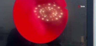 Yıllarca fark etmedi, estetik ameliyatta ortaya &ccedil;ıktı: Burunda rinolit şoku!