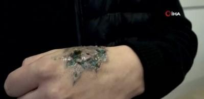 Eline yaptırdığı d&ouml;vme hayatını kabusa &ccedil;evirdi