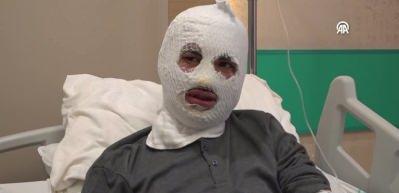 &Ccedil;akmağına gaz doldurduğu t&uuml;p&uuml;n patlamasıyla y&uuml;z&uuml; yandı