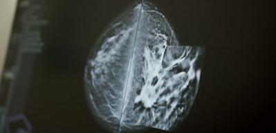 Uzmanından kritik a&ccedil;ıklama: Meme kanserinde hayat kurtaran yenilik