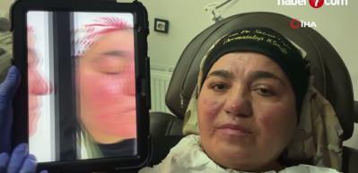 Hastalığı y&uuml;z&uuml;nden yıllarca evden &ccedil;ıkamadı, şimdi ise &ccedil;ekinmeden &ccedil;ıkabiliyor