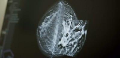 Meme kanseri taramasında yeni teknoloji: ABUS ile daha net g&ouml;r&uuml;nt&uuml;