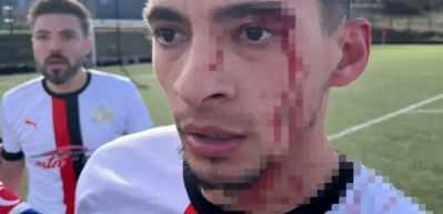 Yeşil sahada kan g&ouml;vdeyi g&ouml;t&uuml;rd&uuml;: 3 futbolcu hastanelik oldu