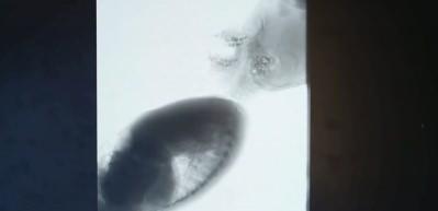 Basit bir &ouml;ks&uuml;r&uuml;n demeyin! &Ccedil;ocuklardaki riskli solunum belirtileri hayati alarm olabilir