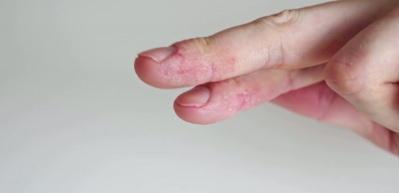 Uzman isim uyardı: Egzaması olan &ccedil;ocuklarda gereksiz diyet alerjiyi tetikleyebilir