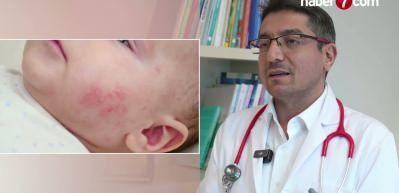 Uzmanından uyarı: Egzamalı &ccedil;ocuğa ezbere diyet yaptırmayın