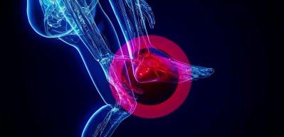 Kronik topuk dikeninde &ccedil;ığır a&ccedil;an y&ouml;ntem: Anjiyografik m&uuml;dahale