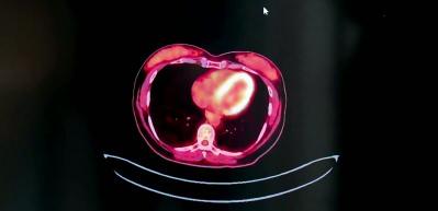 V&uuml;cudunuzun sessiz uyarıları: Kanser &ouml;ncesi belirtileri g&ouml;z ardı etmeyin!