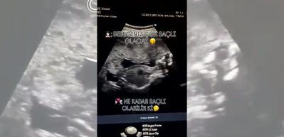 Doktor "Bebeğiniz g&uuml;r sa&ccedil;lı olacak" dedi! Tahmini doğru &ccedil;ıktı