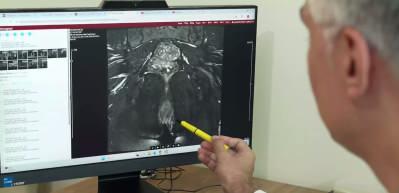Rektum kanserinde yeni d&ouml;nem: Bazı hastalarda ameliyat yerine yakın takip