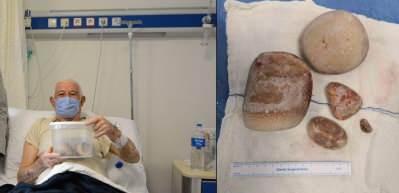 73 yaşındaki yaşlı adamın mesanesinden 2 kilo taş &ccedil;ıktı!