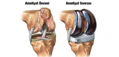 Ağrısız diz protez ameliyatı nasıl yapılır?