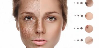 Cilt lekelerini gideren 4 y&ouml;ntem