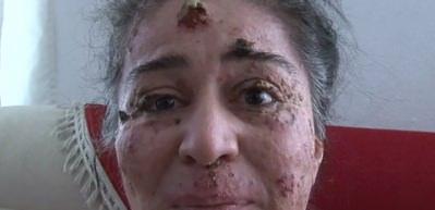 G&uuml;neşin erittiği kadın! Organlarını bir bir kaybediyor