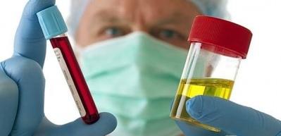 İdrarda kanama neden olur? Hangi idrar rengi hangi hastalığın habercisidir?