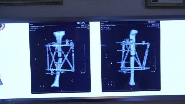 Boy kısalığı artık tarih oluyor! Kemik uzatma ameliyatları artık doğal iyileşme vadediyor