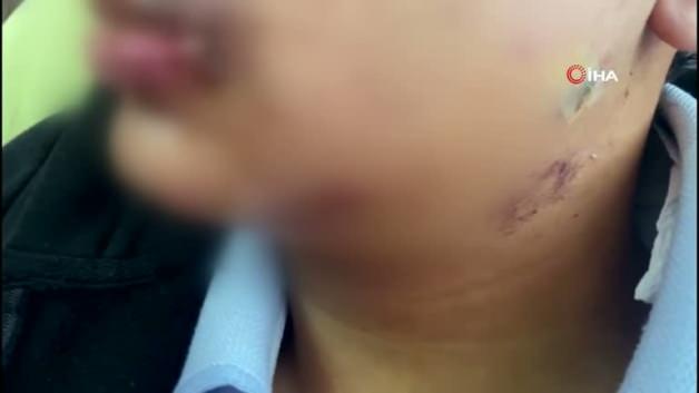 Antalya’da akran zorbalığı yürekleri yaktı! Lise öğrencisinin çenesini kırdılar Antalya’da akran zorbalığı yürekleri yaktı! Lise öğrencisinin çenesini kırdılar