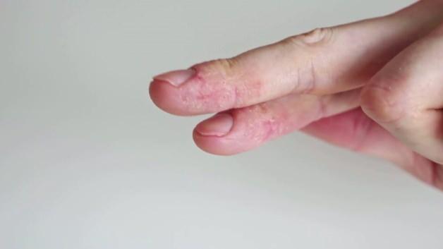 Uzman isim uyardı: Egzaması olan &ccedil;ocuklarda gereksiz diyet alerjiyi tetikleyebilir