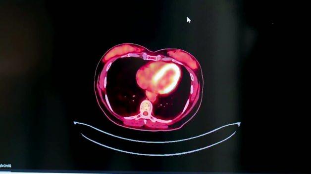 V&uuml;cudunuzun sessiz uyarıları: Kanser &ouml;ncesi belirtileri g&ouml;z ardı etmeyin!