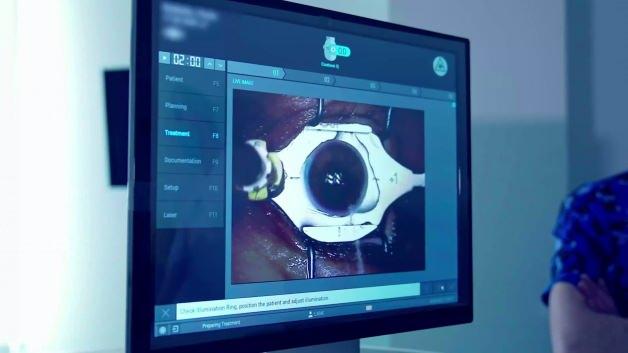 G&ouml;zl&uuml;k ve lens tarih oluyor: Lazerle kalıcı &ccedil;&ouml;z&uuml;m