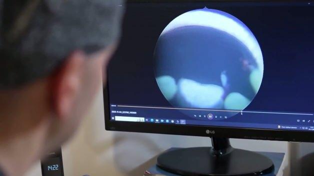 Mesane kanserinde sinsi tehlike: "İdrardaki her kanama hayati &ouml;nem taşıyor"