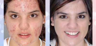 Roaccutane yan etkileri nelerdir ?