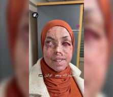 İsrail'in fosfor bombasıyla ağır yaralanan genç kızın hali gözyaşlarına boğdu