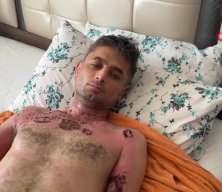 Gaziosmanpaşa'da engelli kişiye yönelik gasp ve üzerine kimyasal sıvı dökülerek yakılma iddiası