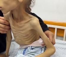 Alman basını Gazze’deki açlık fotoğraflarını ‘propaganda’ diye hedef aldı