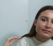 Uzman isim uyardı: Yetişkinler akne sorunuyla karşı karşıya