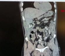 3 bin kilometre uzaktan midesinde uyuşturucu getirdi!